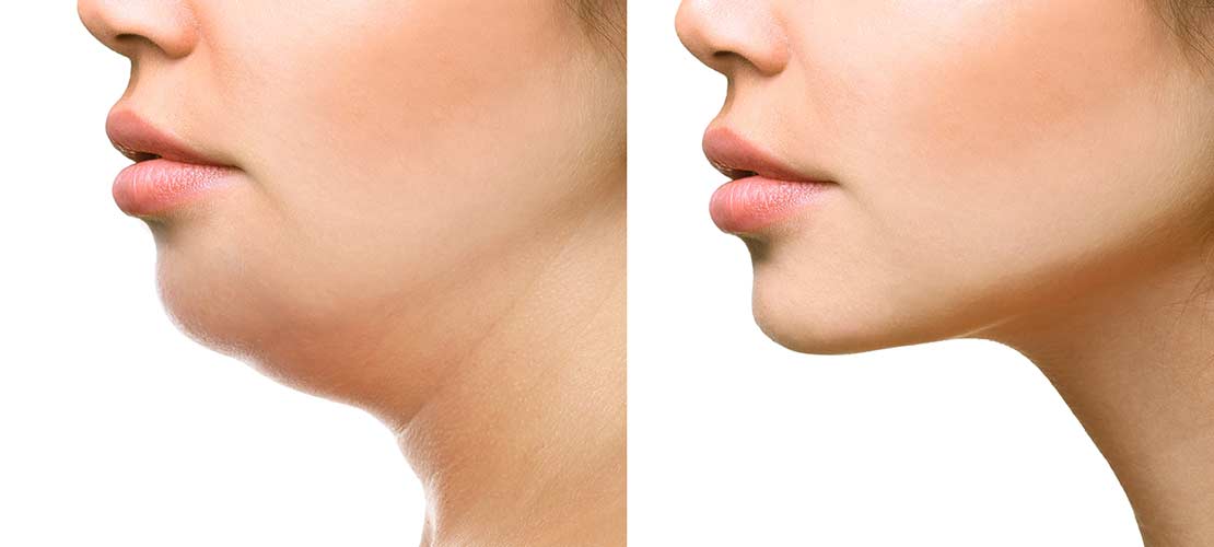 Kybella Injections before and After