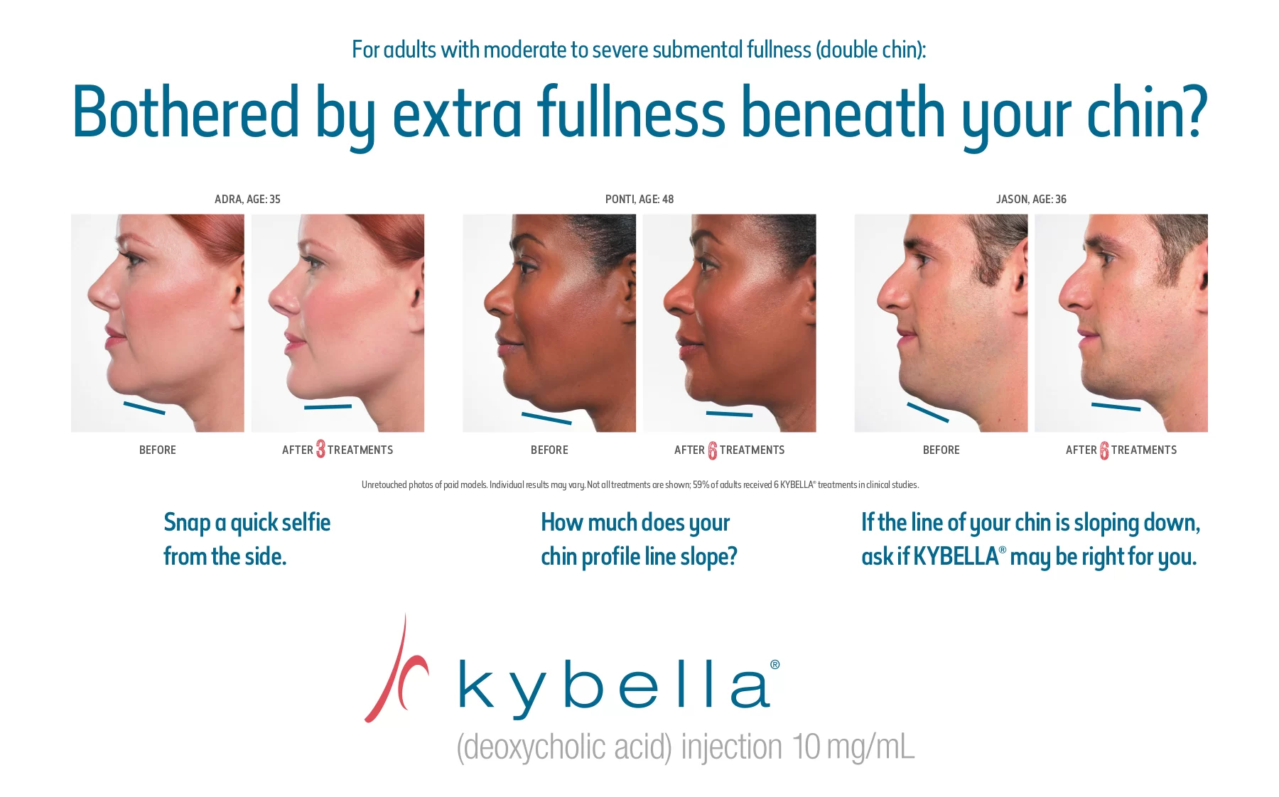 Kybella Injections Double Chin Treatment