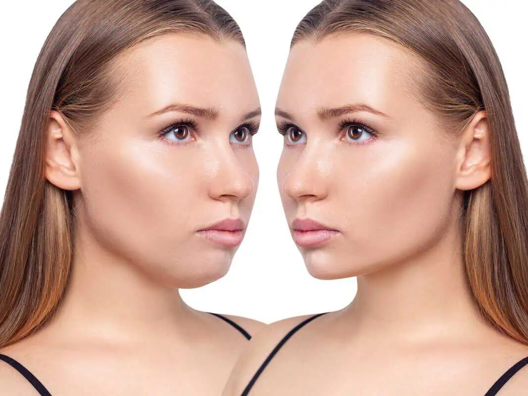 Kybella Injections before and After