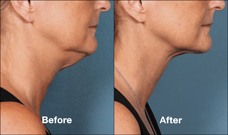 Kybella Injections before and After