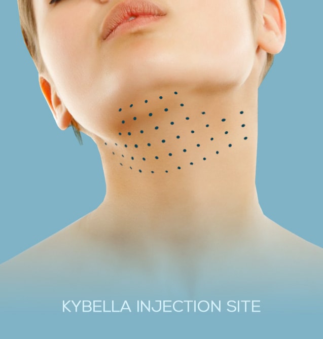 Kybella Injections