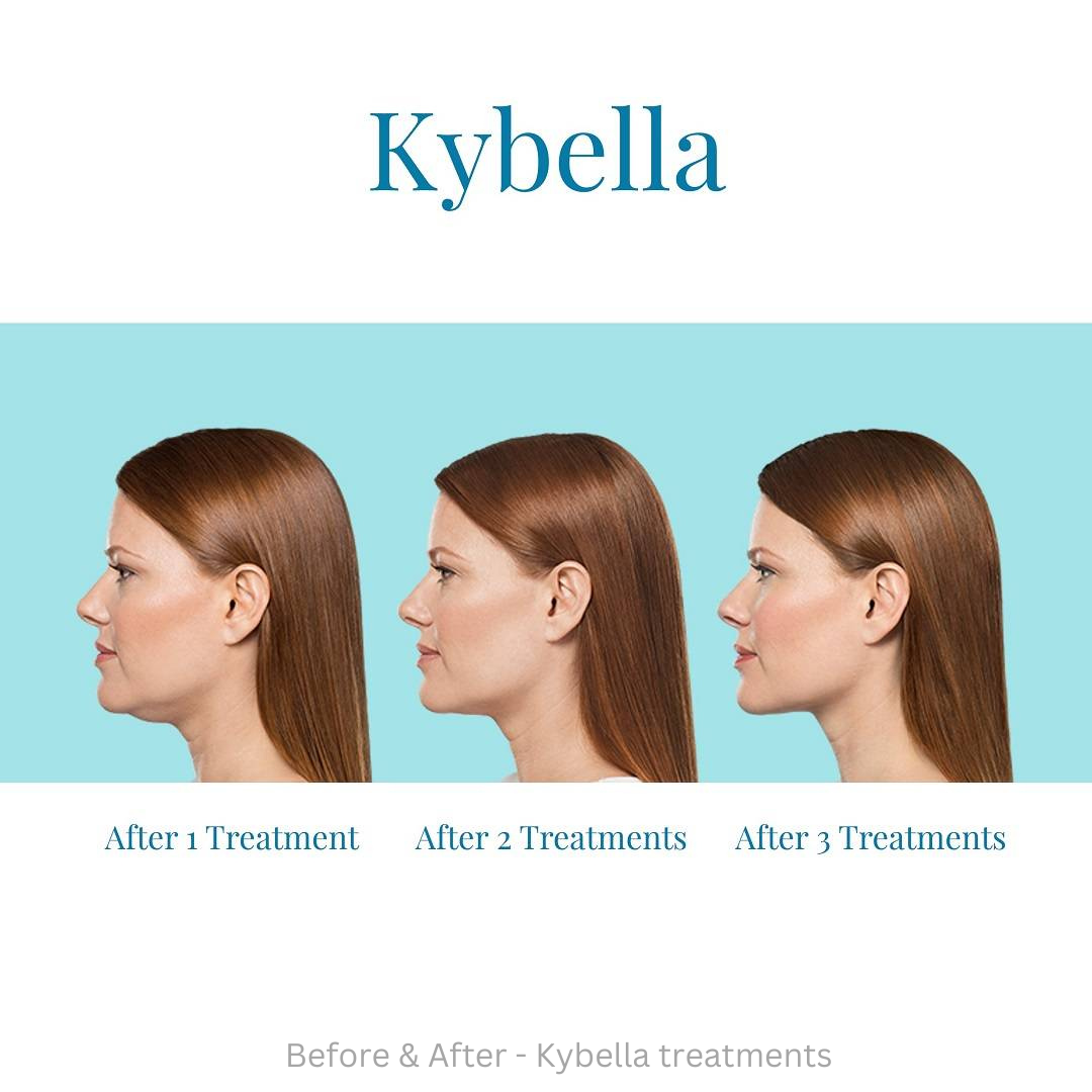 Kybella Injections Treatments