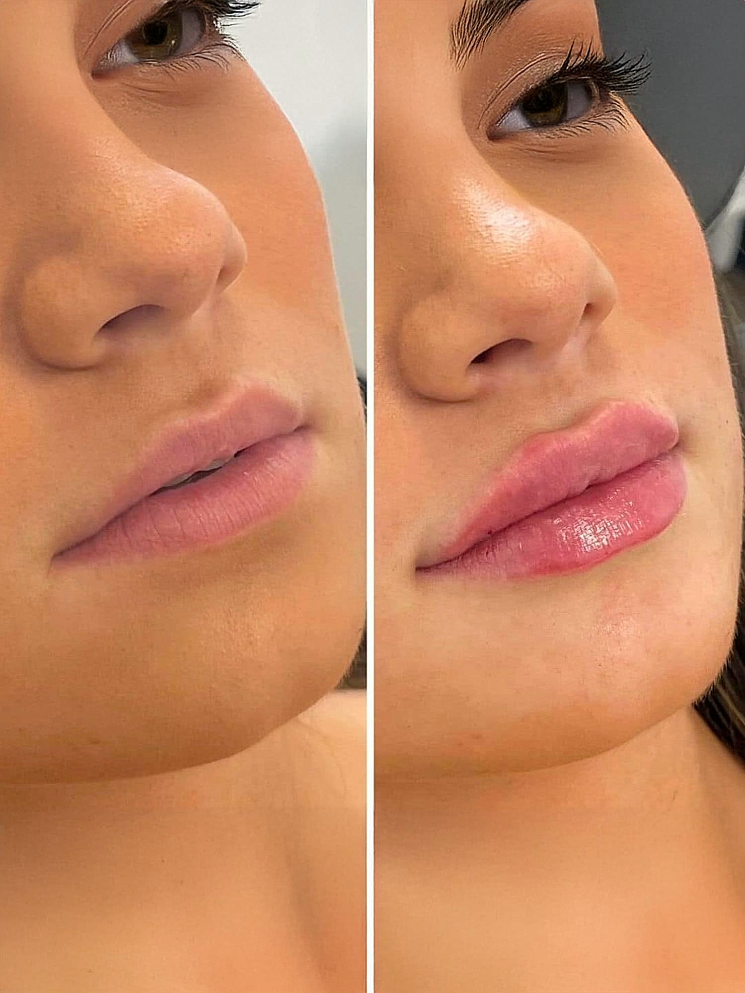 Lip Fillers