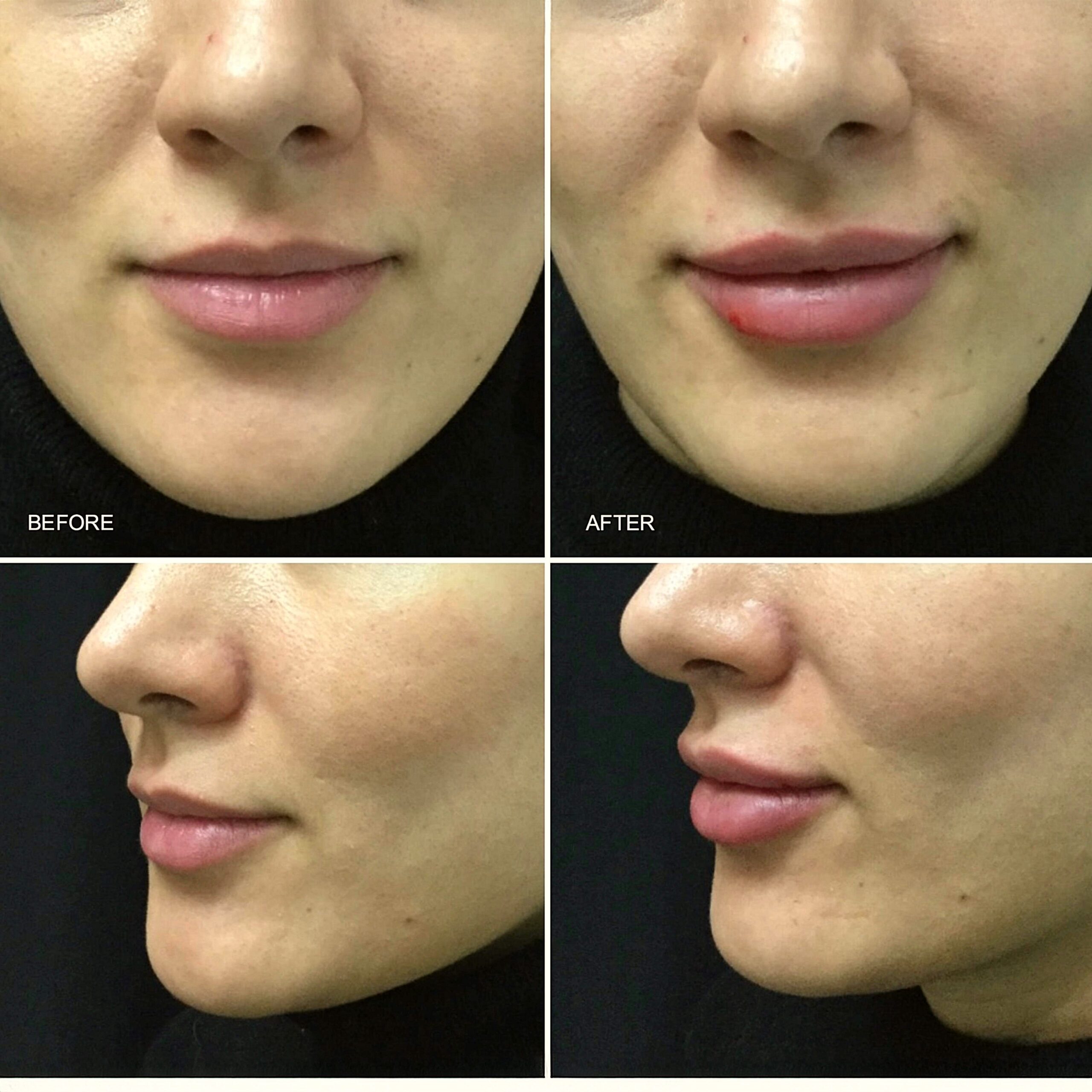 Lip Fillers