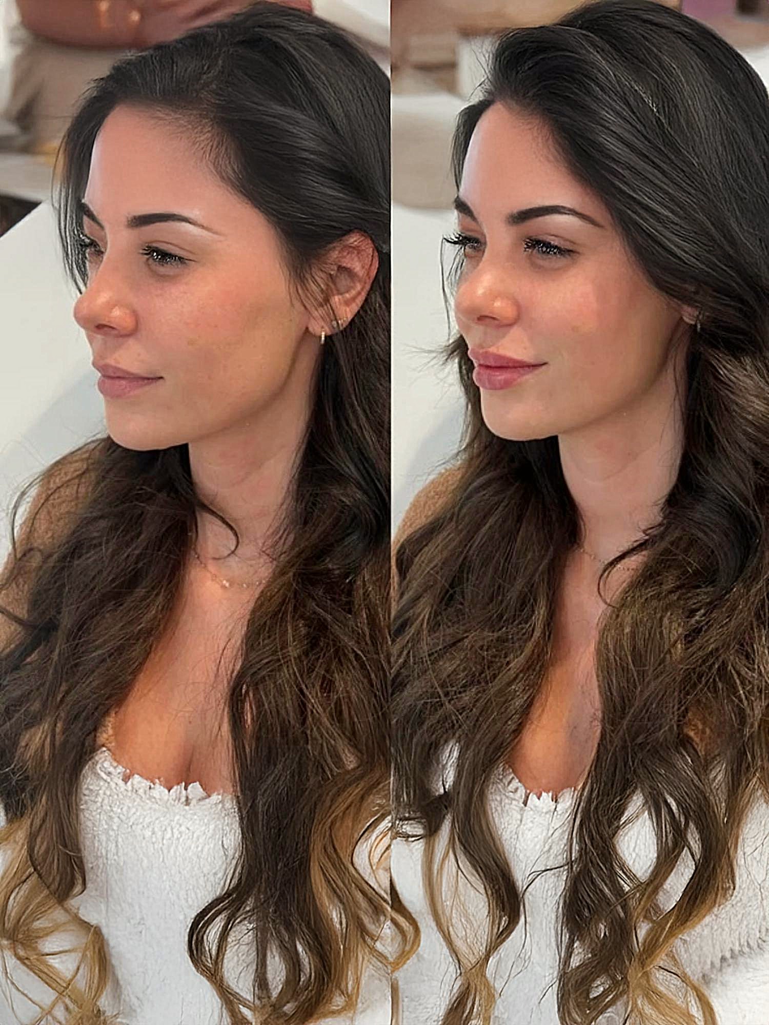Lip Fillers