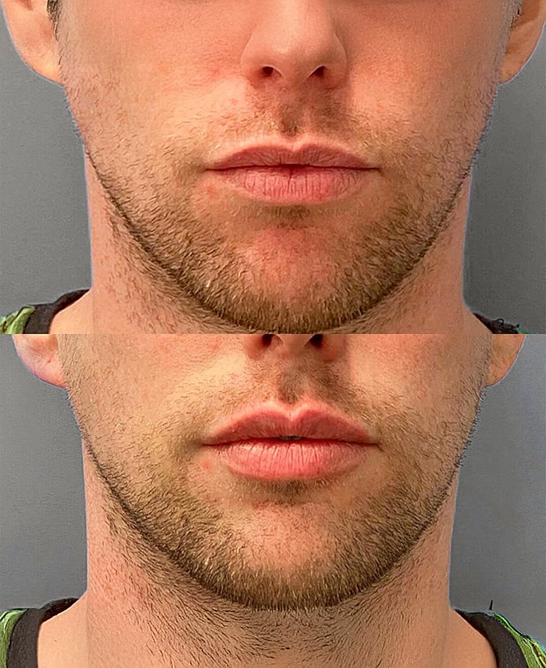 Lip Fillers