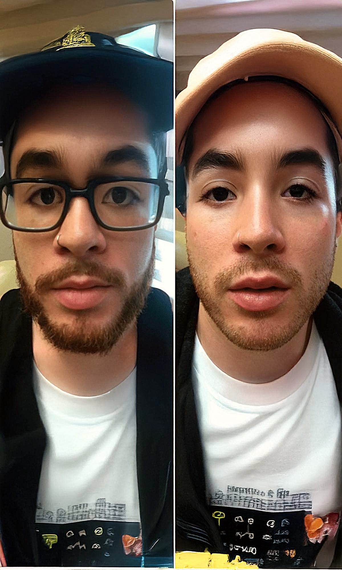 Lip Fillers