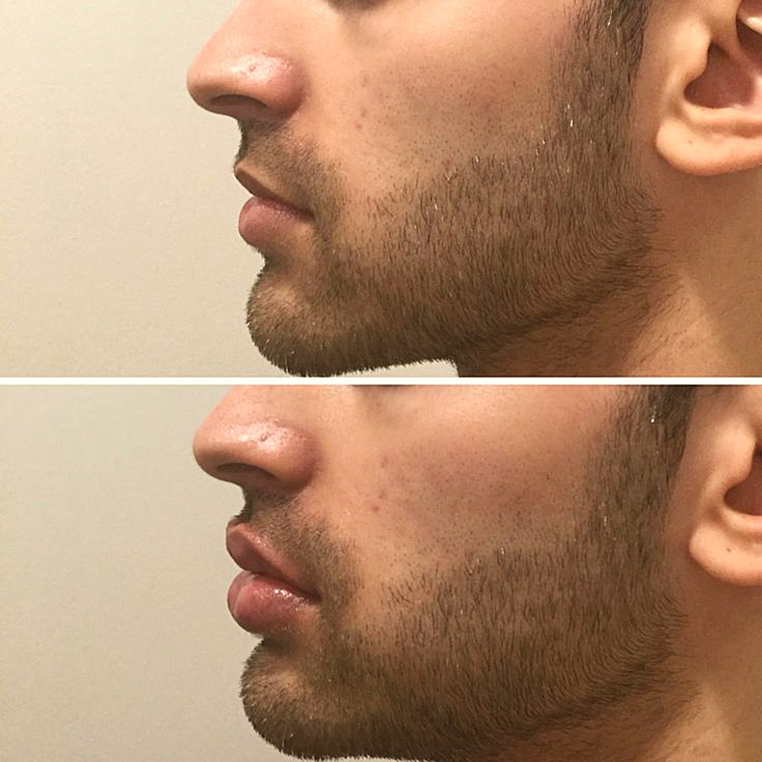 Lip Fillers