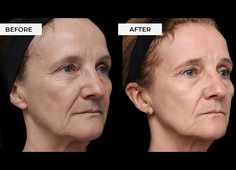 Morpheus8 Before and after