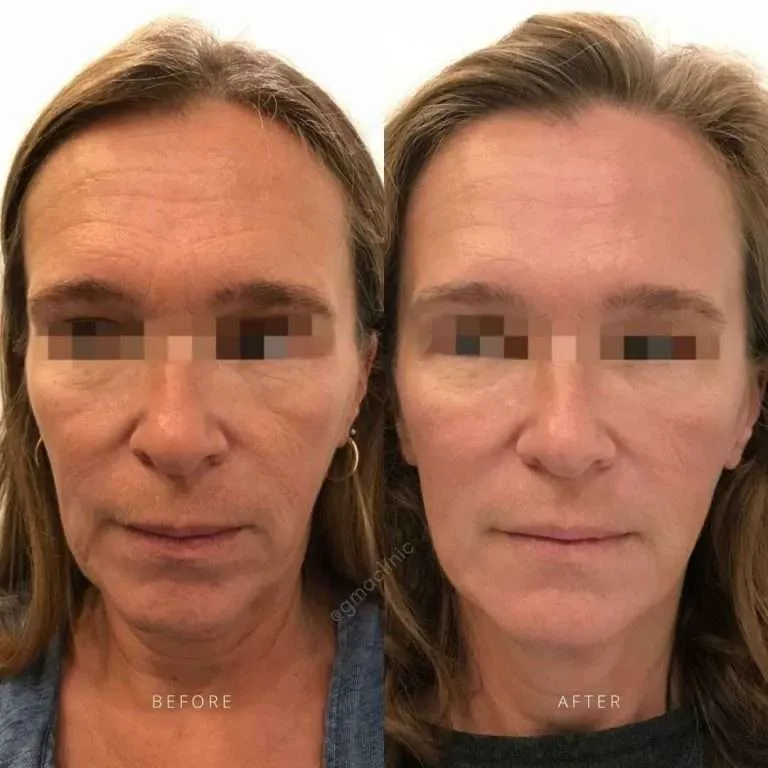 Before and after