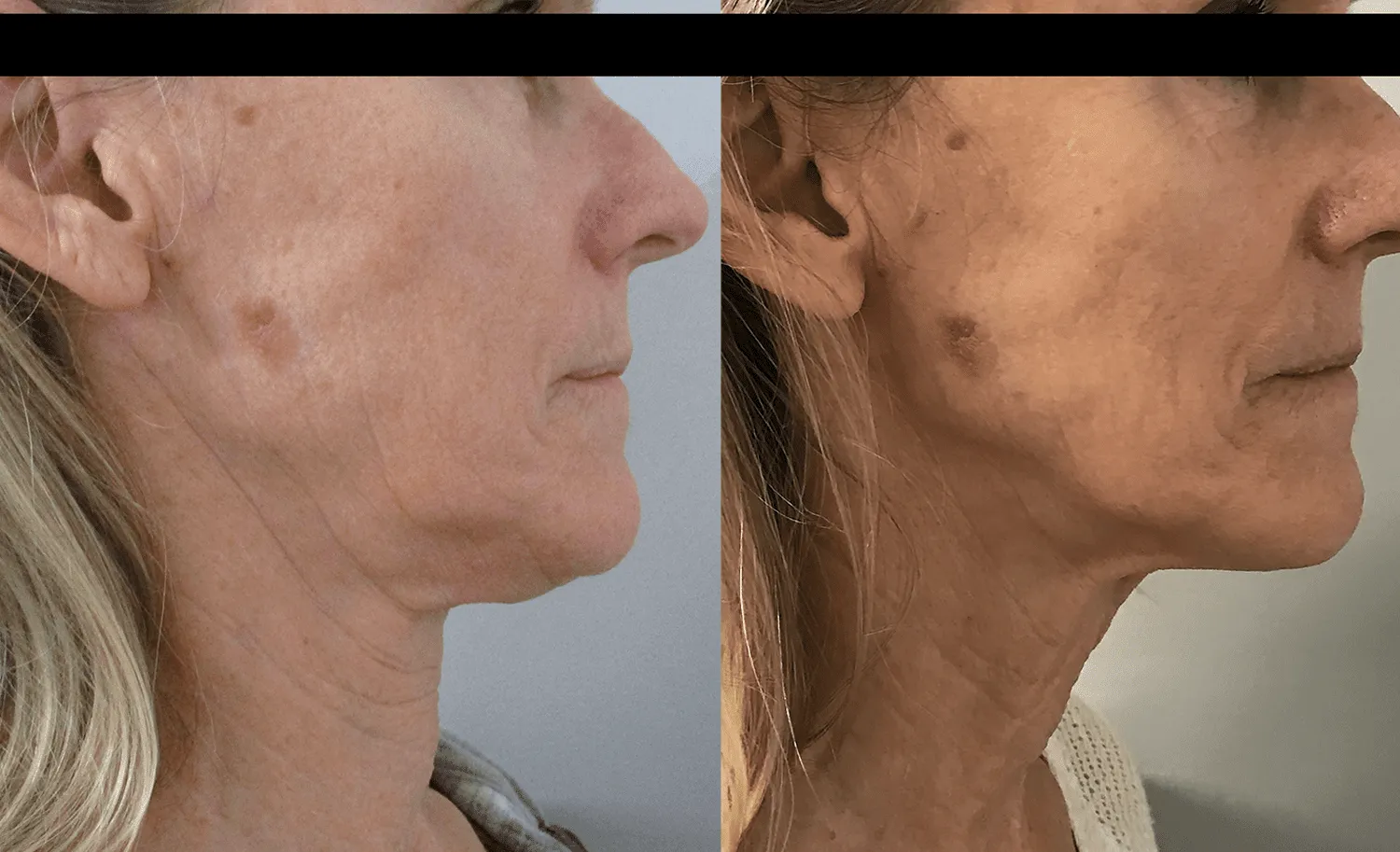 before and after