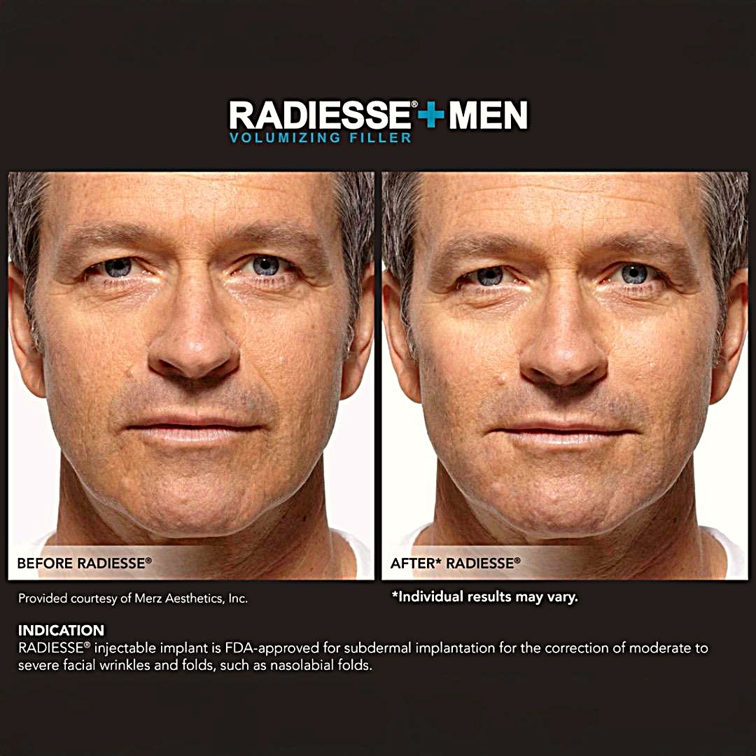 Radiesse Before and after
