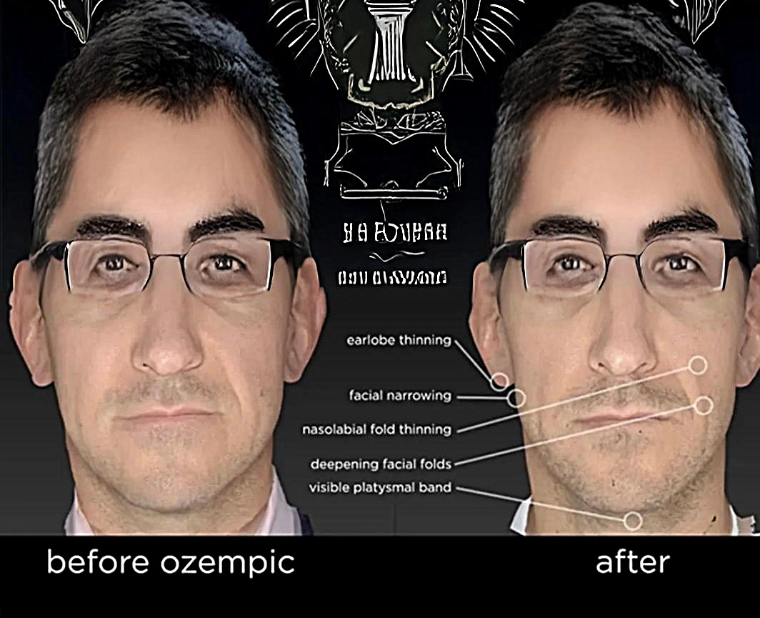 Ozempic before amd after