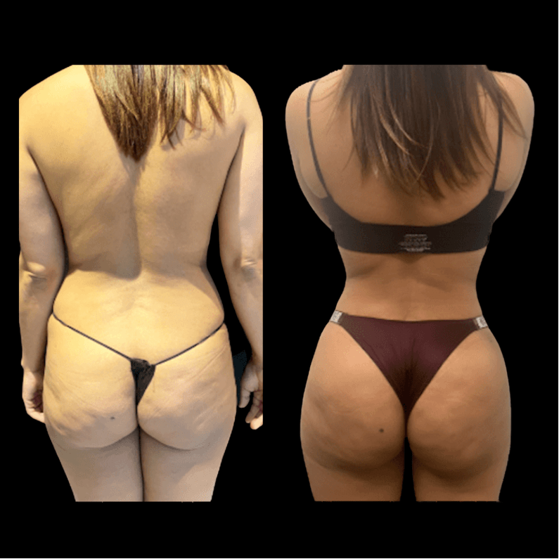 Before and After Image: Butt Lift - back
