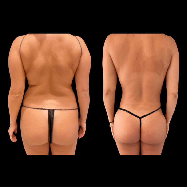 Before and After Image: Butt Lift - front