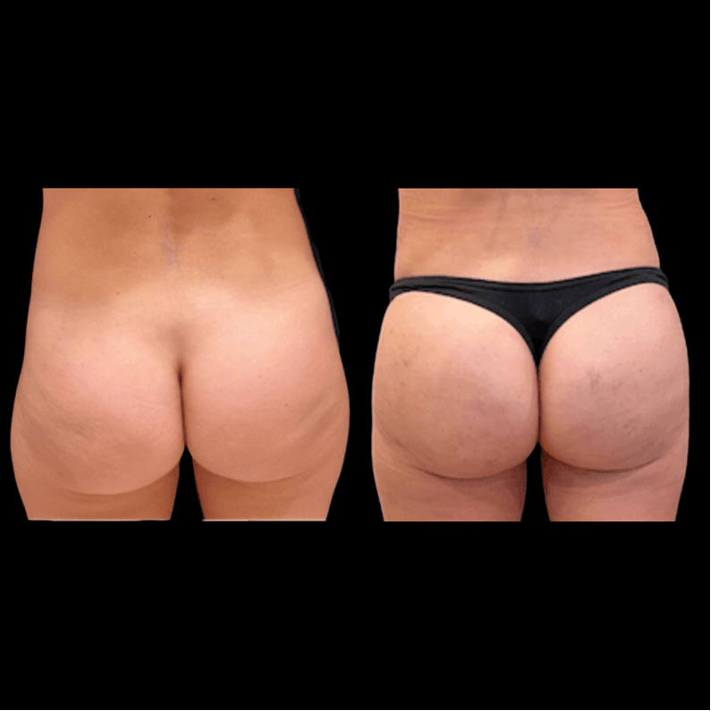 Before and After Image: Butt Lift - front