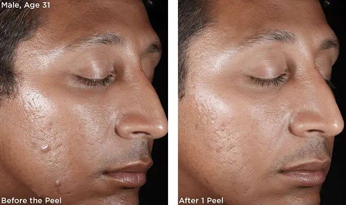 Before and After Image: Chemical Peel - right-front-oblique