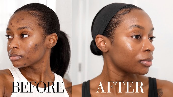 Before and After Image: Chemical Peel - other