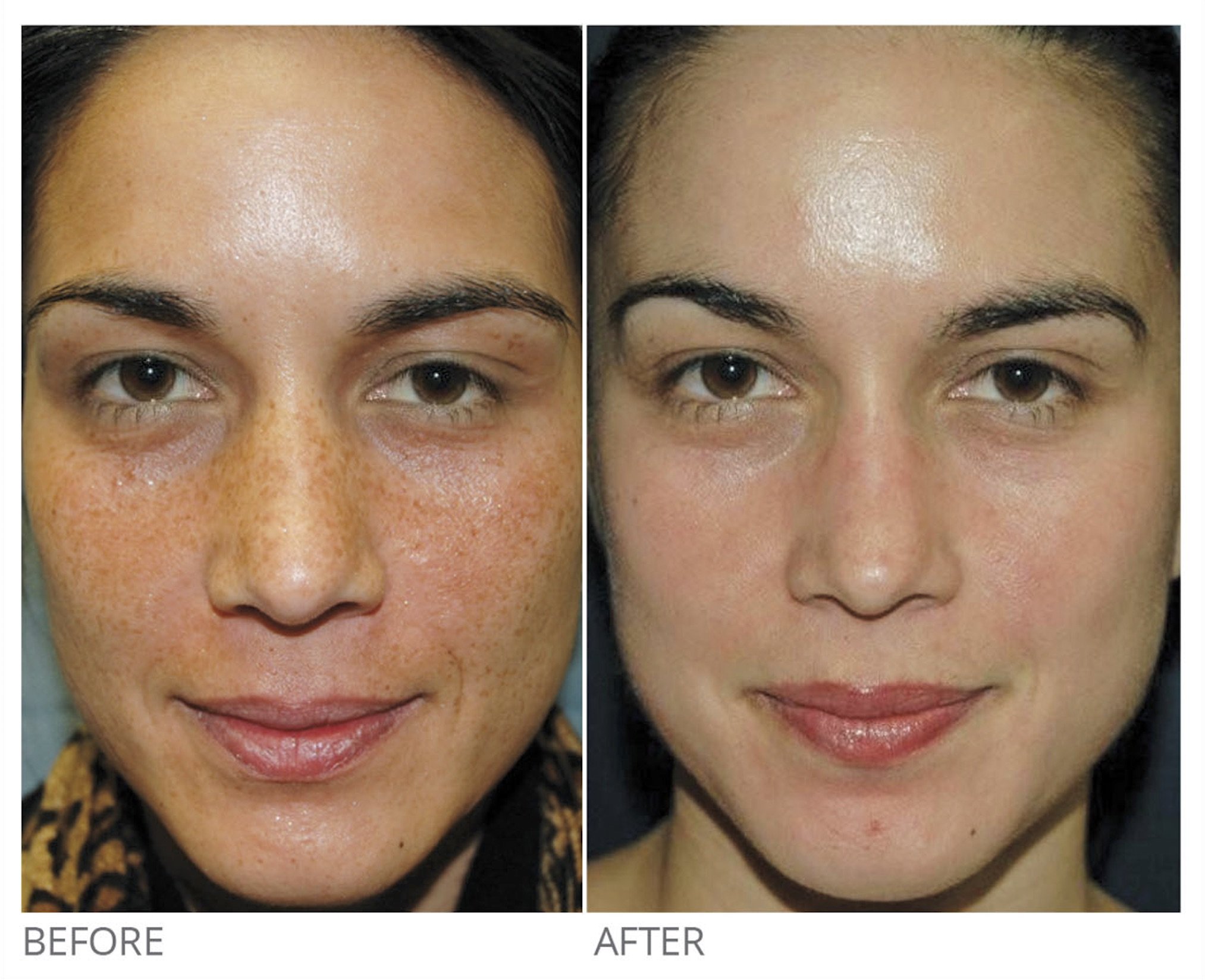 Before and After Image: Chemical Peel - front