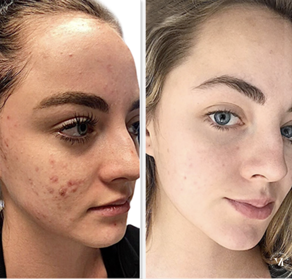 Before and After Image: Chemical Peel - right-front-oblique