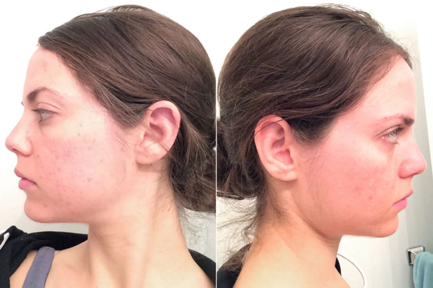 Before and After Image: Clear + Brilliant - left-side