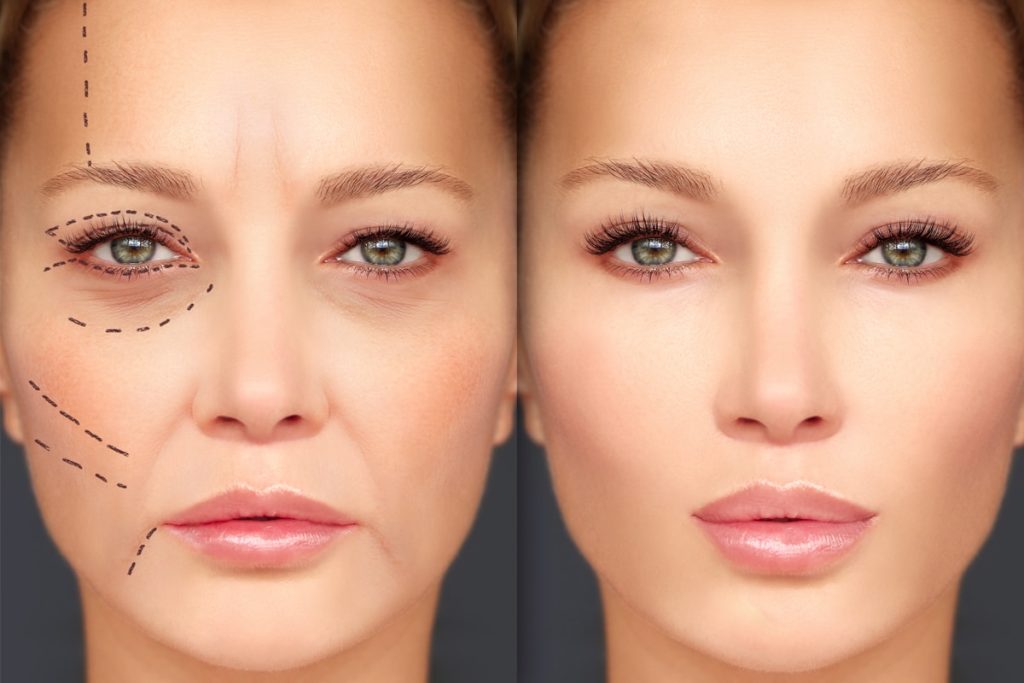 Before and After Image: Dermal Fillers - front