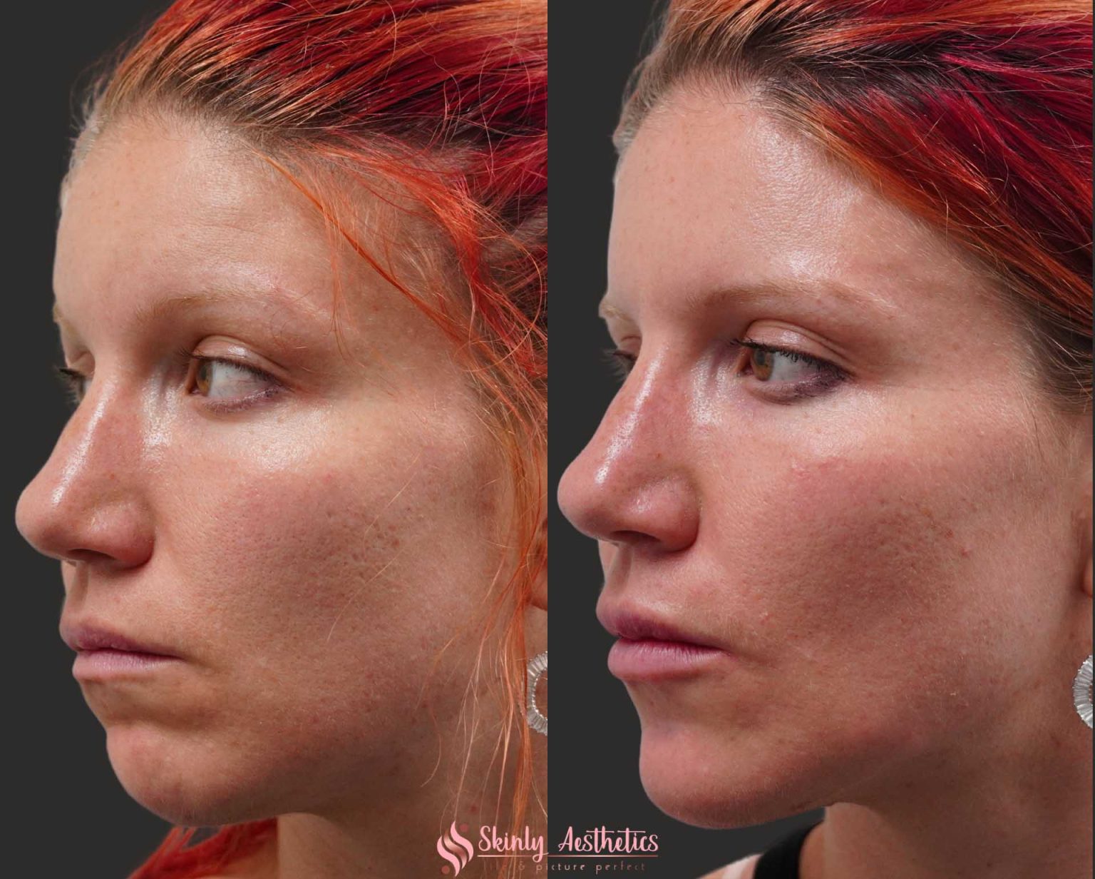 Before and After Image: Dermal Fillers - left-front-oblique