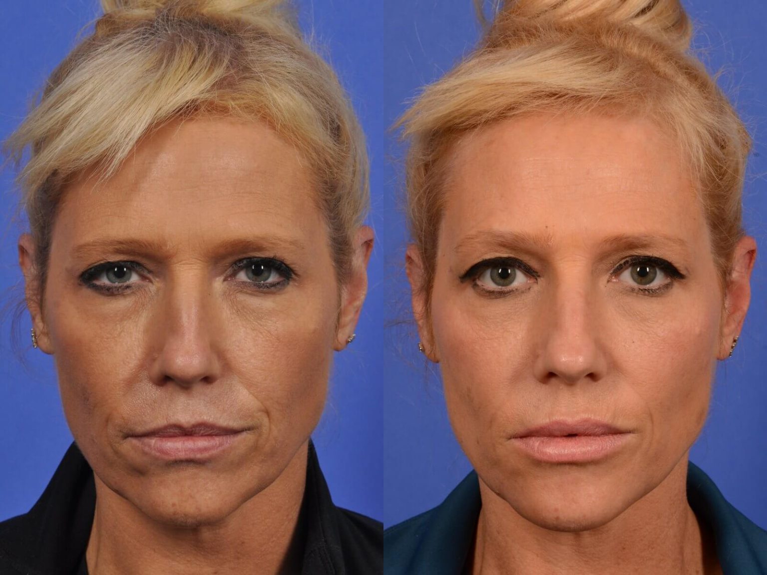Before and After Image: Dermal Fillers - front
