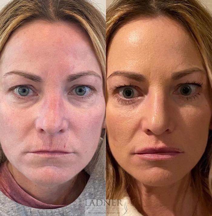 Before and After Image: Dermal Fillers - front