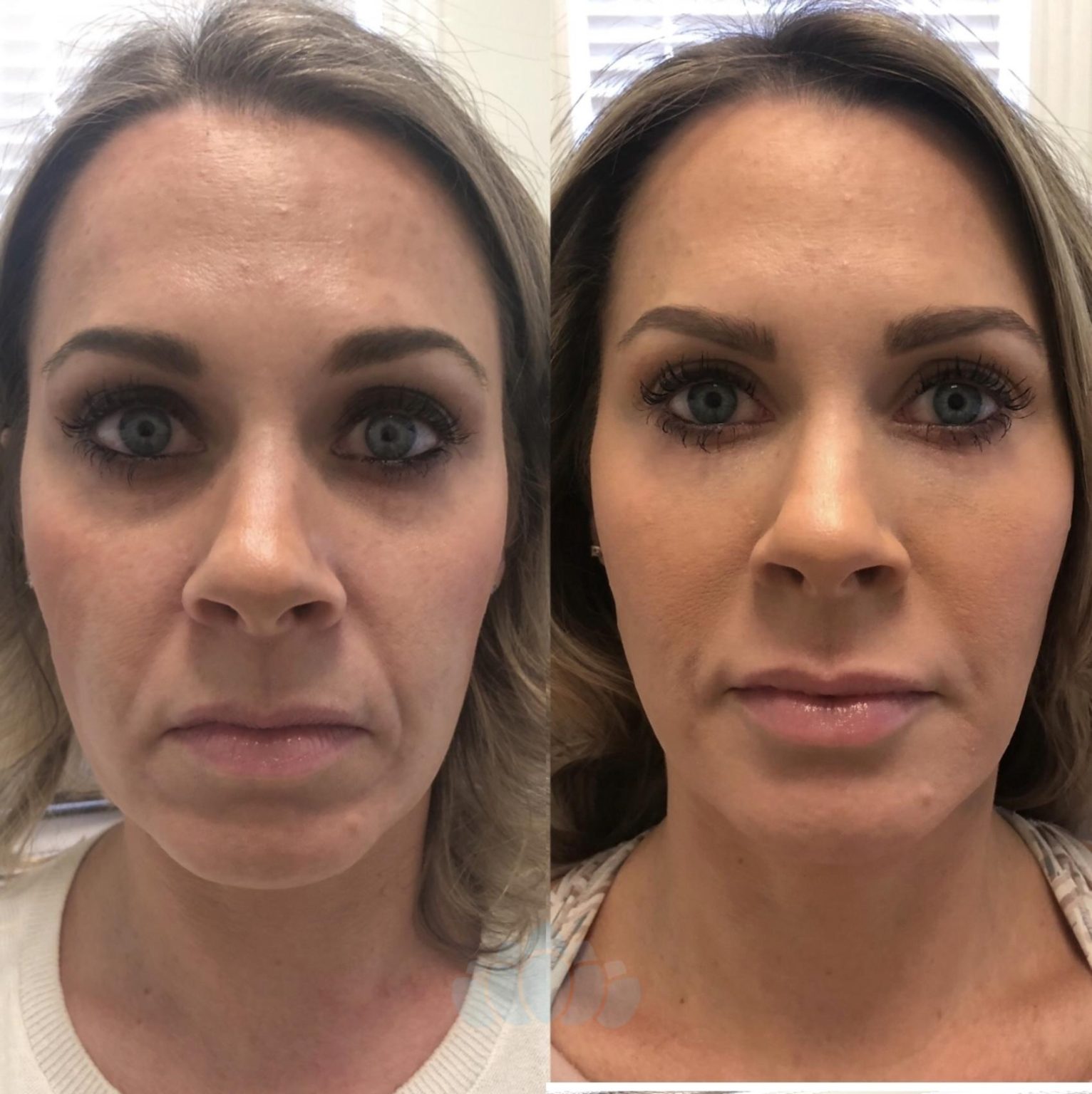 Before and After Image: Dermal Fillers - front