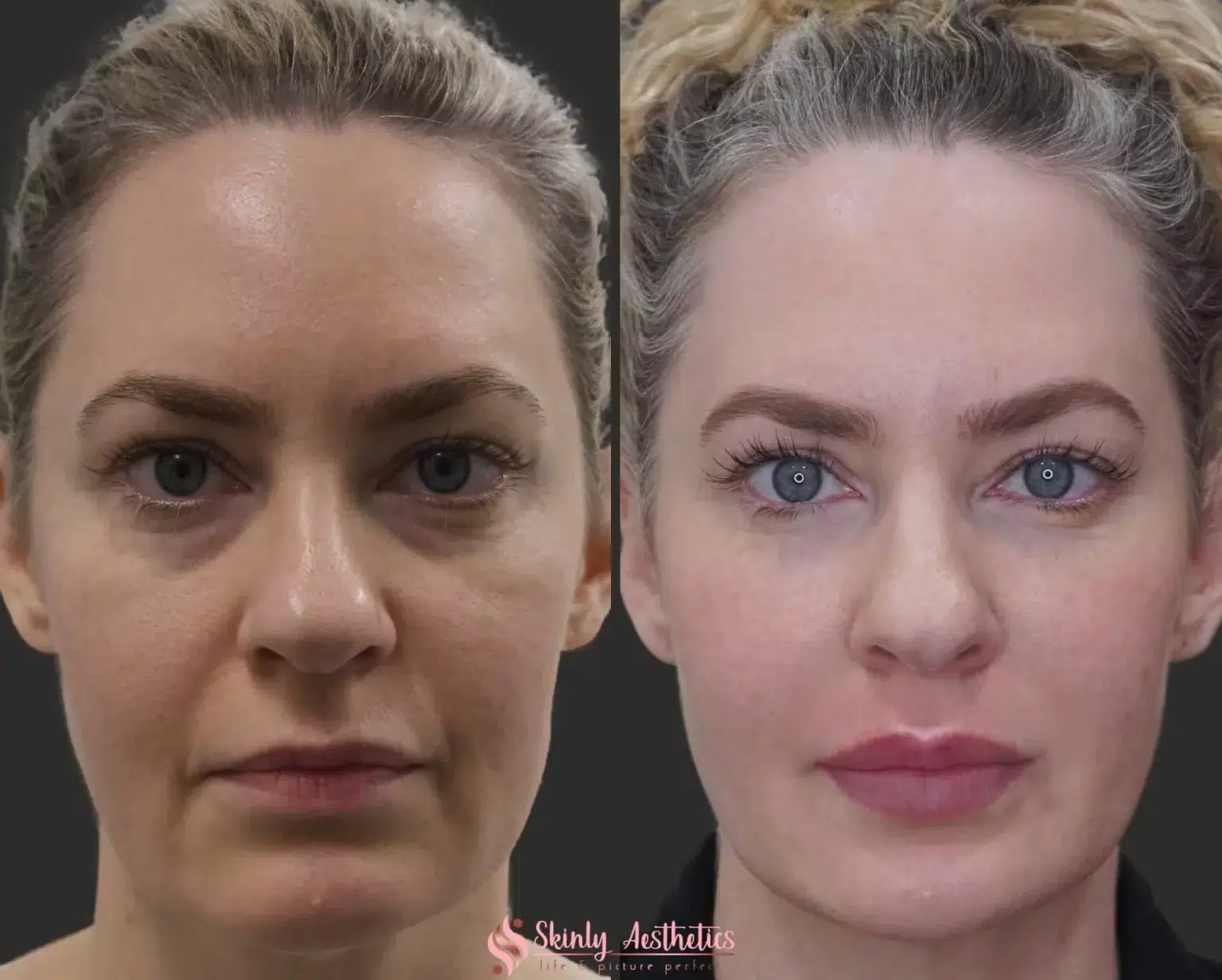 Before and After Image: Dermal Fillers - front