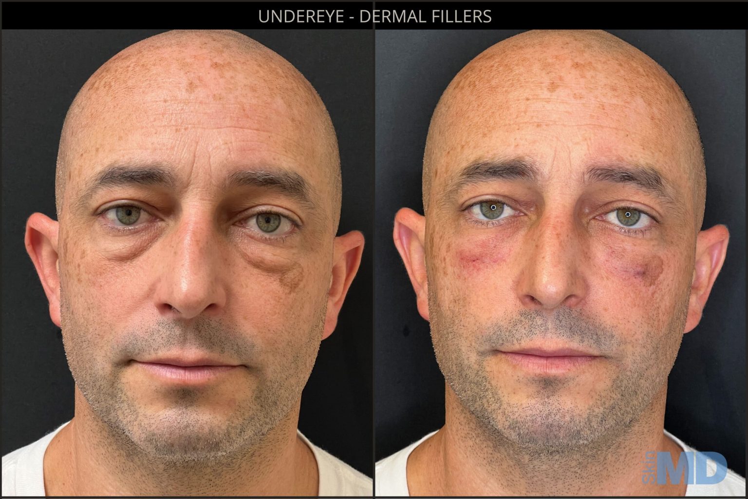Before and After Image: Dermal Fillers - front