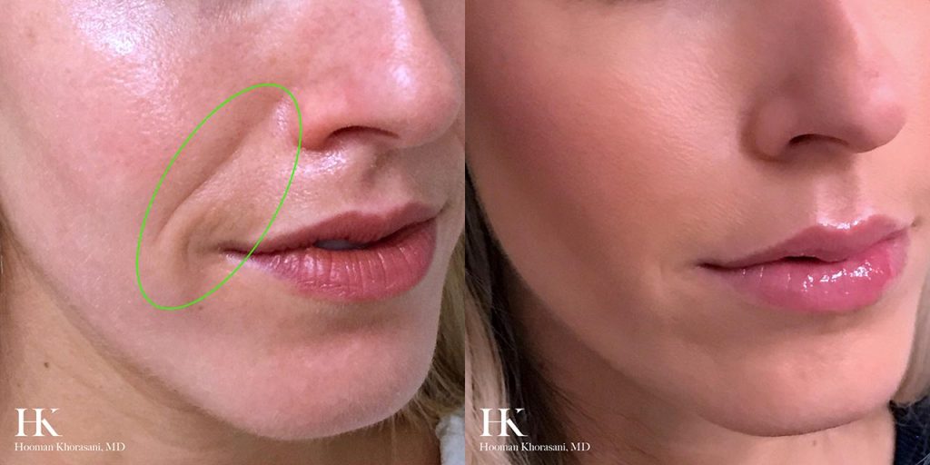 Before and After Image: Dermal Fillers - right-front-oblique