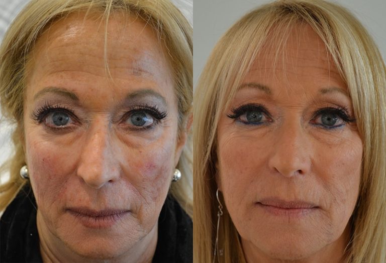 Before and After Image: Dermal Fillers - front