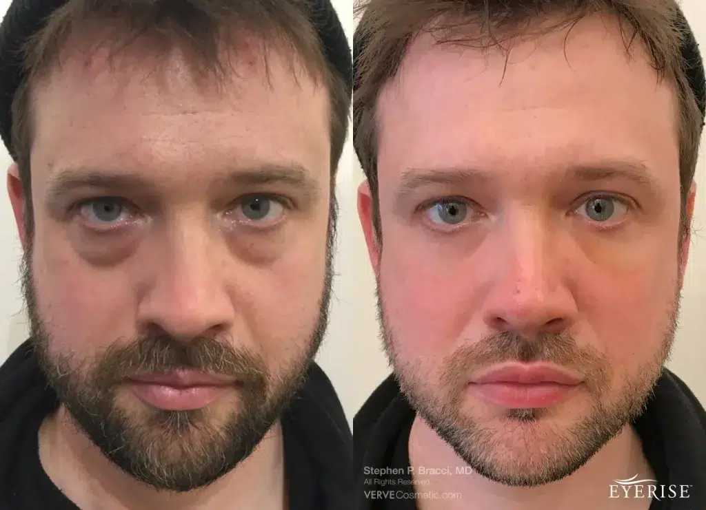Before and After Image: Dermal Fillers - front