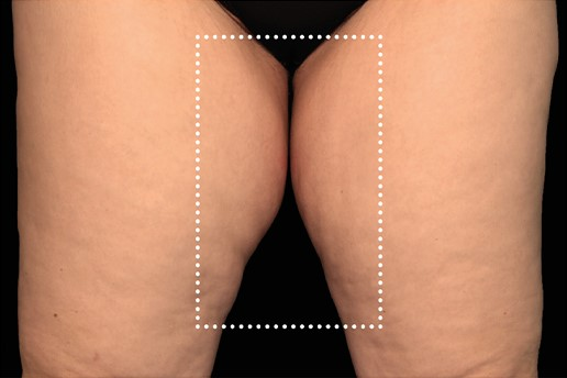 Before and After Image: Emsculpt Neo - front