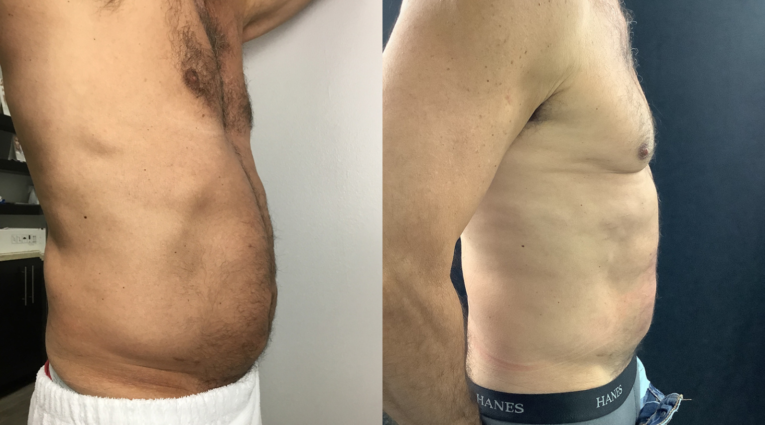 Before and After Image: Emsculpt Neo - right-side