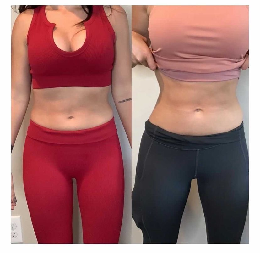 Before and After Image: Emsculpt Neo - front