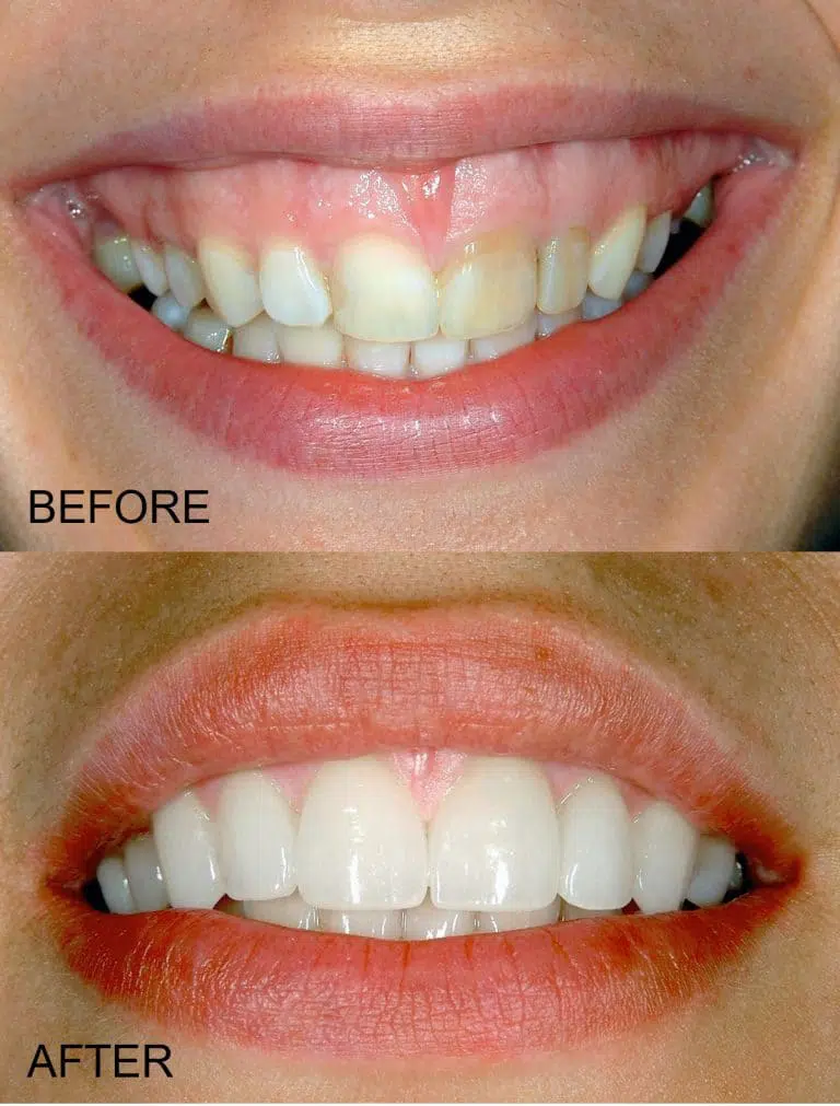 Before and After Image: Gummy Smile - front