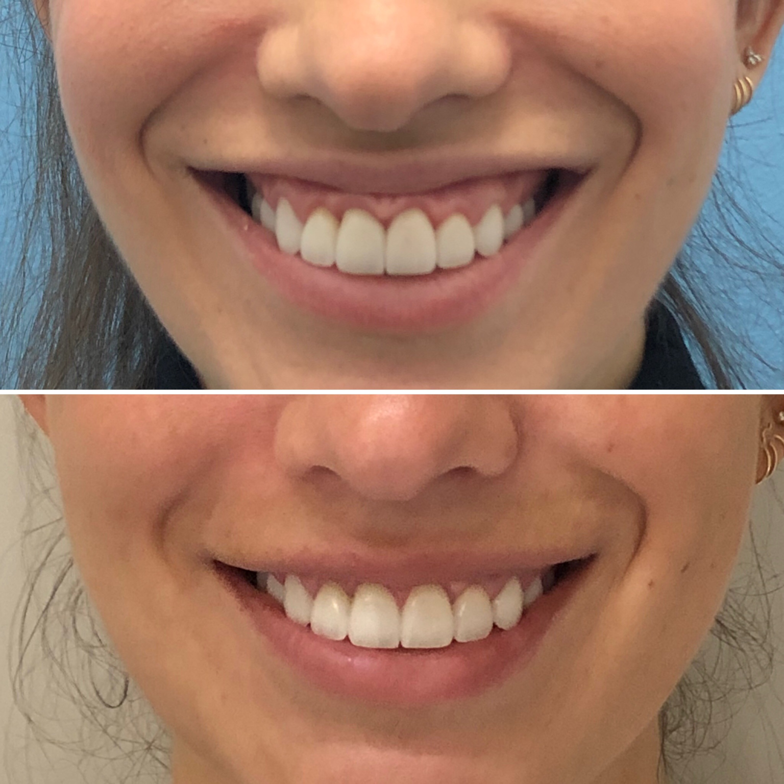 Before and After Image: Gummy Smile - front