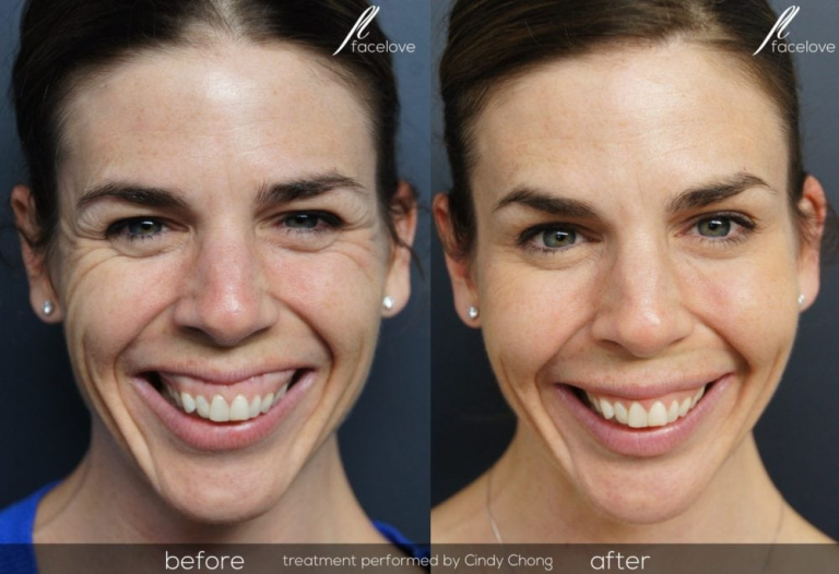 Before and After Image: Gummy Smile - front