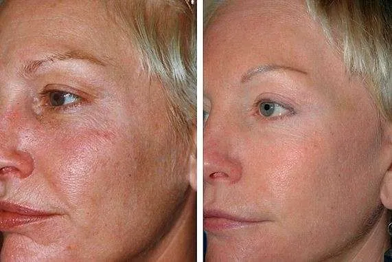 Before and After Image: Laser Hair Removal - left-front-oblique