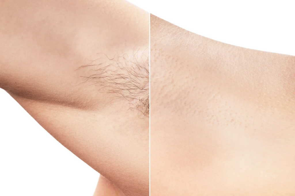 Before and After Image: Laser Hair Removal - front