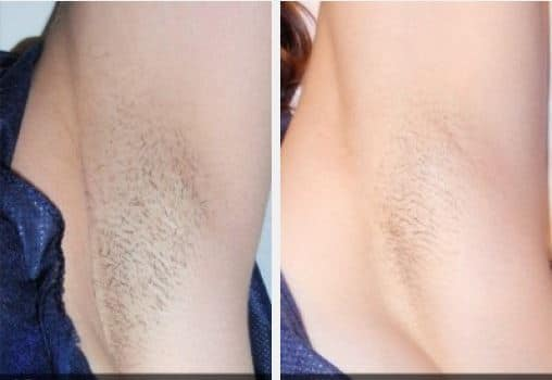 Before and After Image: Laser Hair Removal - front