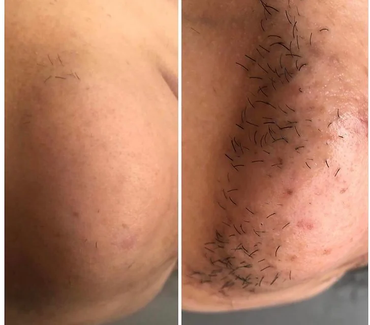 Before and After Image: Laser Hair Removal - front
