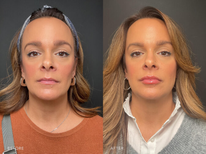 Before and After Image: Lip Filler - front