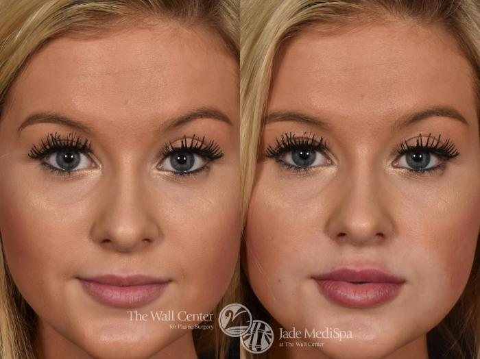 Before and After Image: Lip Filler - front