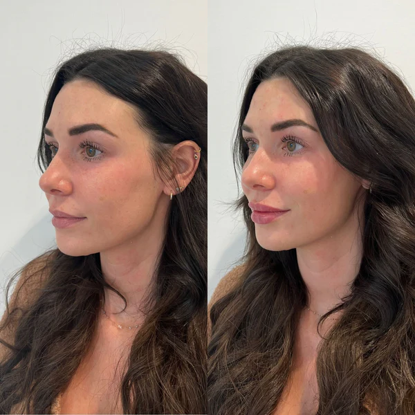 Before and After Image: Lip Filler - left-front-oblique