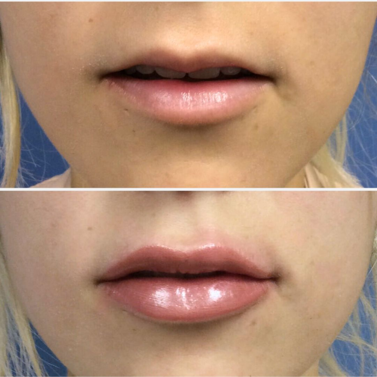 Before and After Image: Lip Filler - front
