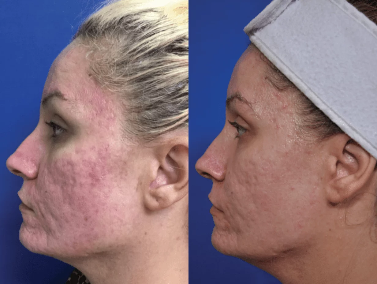 Before and After Image: Microneedling - left-side